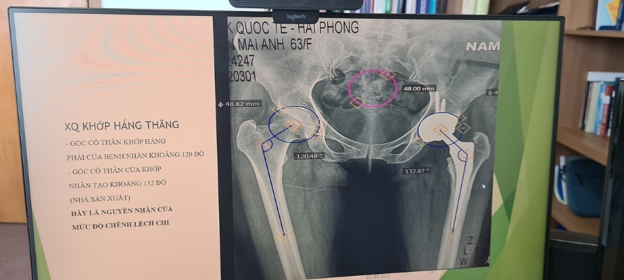 Với độ mở khớp háng phải ( tự nhiên) là 120,48° và khớp háng trái (nhân tạo) 132,87°, cộng với độ nghiêng của 2 khớp không đồng đều là nguyên nhân dẫn đến chân trái bị dài hơn chân phải sau phẫu thuật.