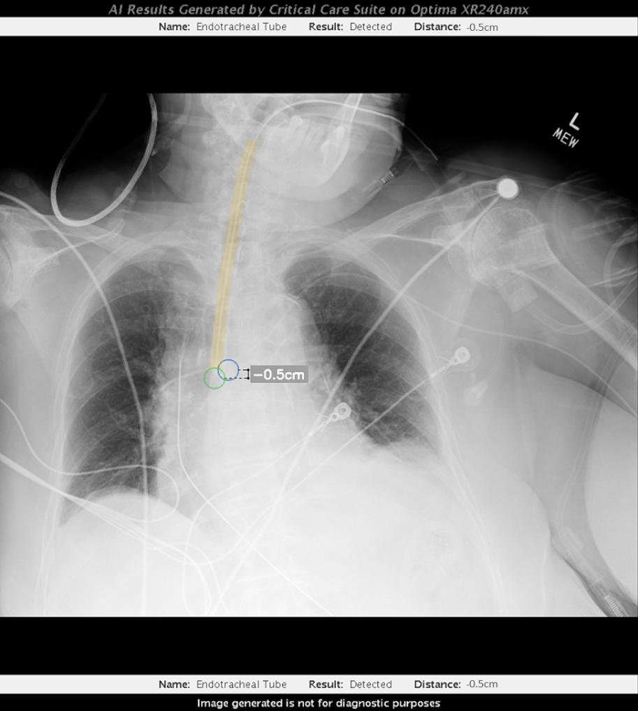 Phần mềm GE sử dụng trí tuệ nhân tạo (AI) nhằm giúp các bác sĩ lâm sàng đánh giá vị trí đặt ống nội khí quản và thực hiện các điều chỉnh quan trọng nhanh hơn. Ảnh Getty Images.